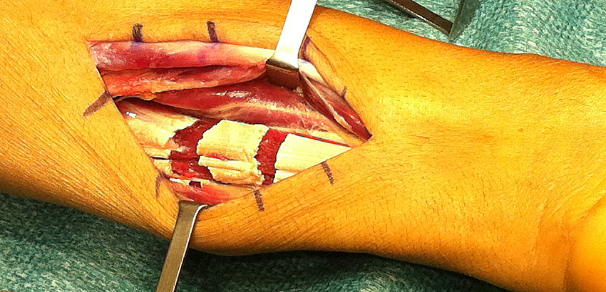allongement-fractionne-tendon